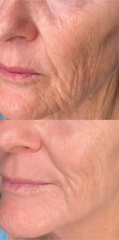 after photo. shows lessened fine lines pigmentation texture